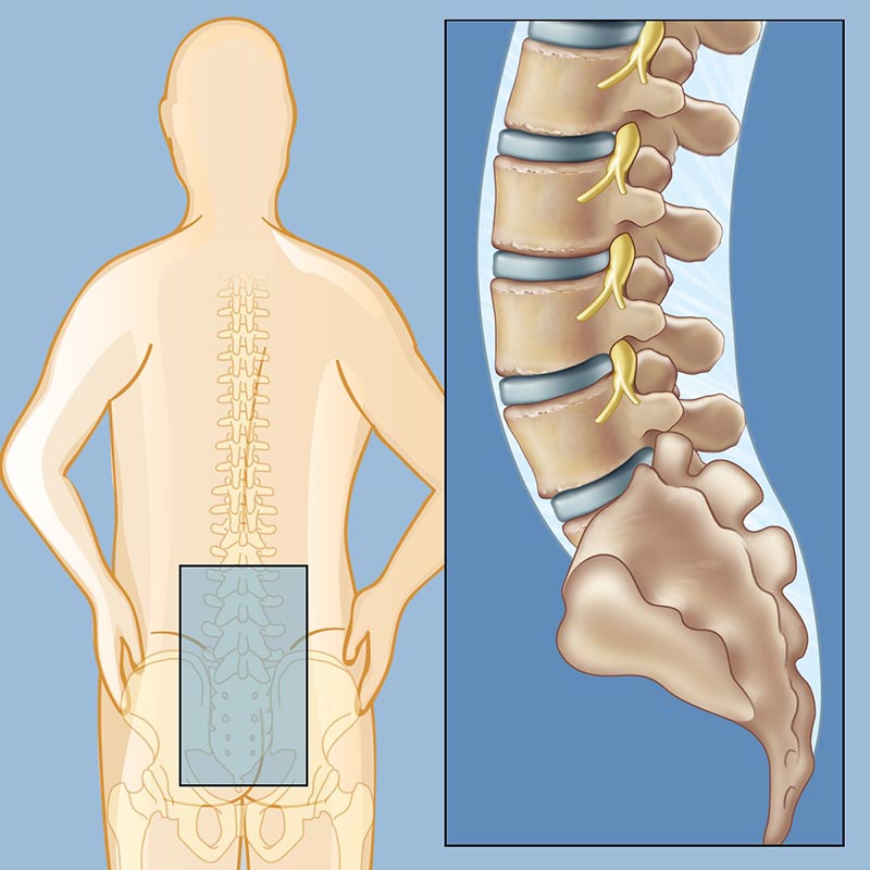 Ảnh 4 của Low back pain